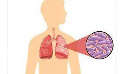 Tăng cường các giải pháp nhằm chấm dứt bệnh Lao vào năm 2030
