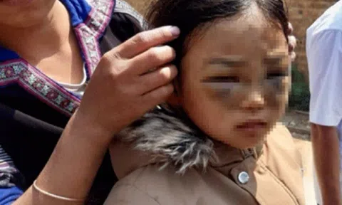 Thông tin mới nhất bé lớp 1 ở Mù Cang Chải bị cô giáo đánh tím 2 mắt