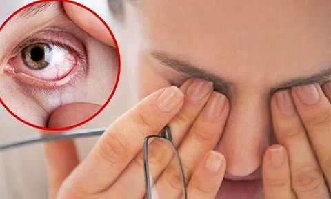 Nhiều người gặp tình trạng khô mắt do nằm điều hòa thường xuyên