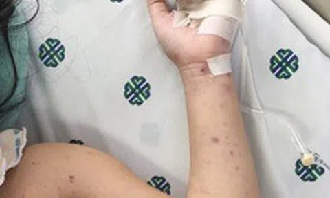 Xuất hiện trẻ bị viêm não mô cầu, cần chủ động phòng bệnh