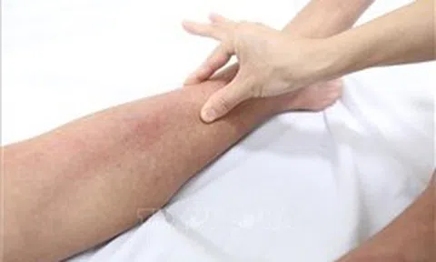 Ghi nhận trên 30.000 ca sốt xuất huyết trong 6 tháng đầu năm 2024