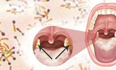 Bộ Y tế yêu cầu khẩn trương giám sát, phát hiện sớm, xử lý triệt để ổ bệnh bạch hầu