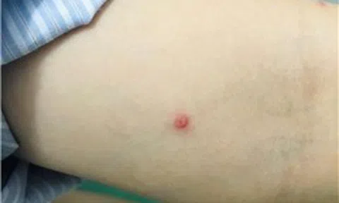 TP Hồ Chí Minh: 100% ca mắc bệnh đậu mùa khỉ đều là nam giới