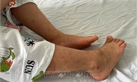 Xuất hiện các ổ dịch sởi trong trường học​ tại TP Hồ Chí Minh