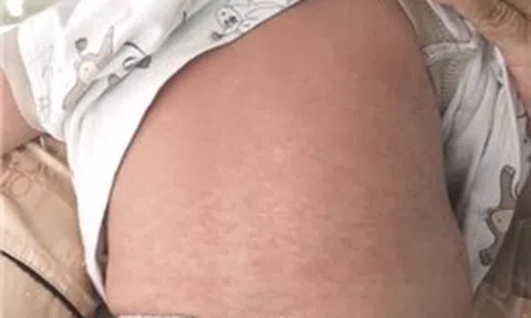 TP Hồ Chí Minh: Dịch sởi gia tăng mạnh, một trẻ tử vong