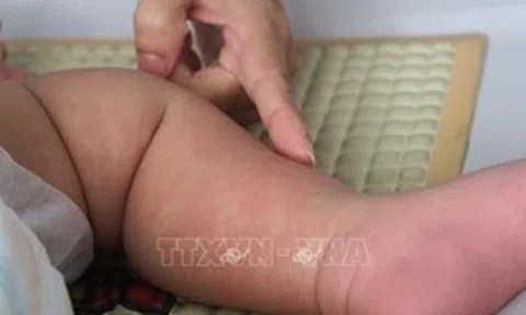 Nguy cơ bùng phát dịch sởi tại Việt Nam rất cao