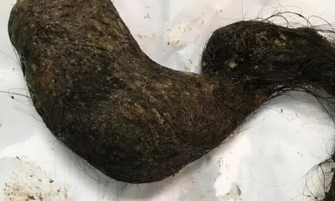 Bé trai bụng cứng như đá, bác sĩ choáng khi phát hiện "bí mật" bên trong