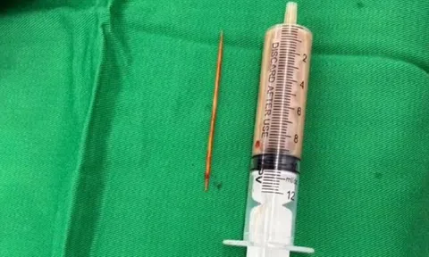 Người đàn ông bụng "cứng như đá" 2 tuần, bác sĩ phát hiện nguyên nhân bất ngờ