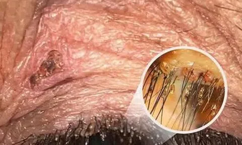 Ngứa mắt khó chịu, người bệnh sốc khi bác sĩ tìm thấy “thủ phạm” ở bờ mi