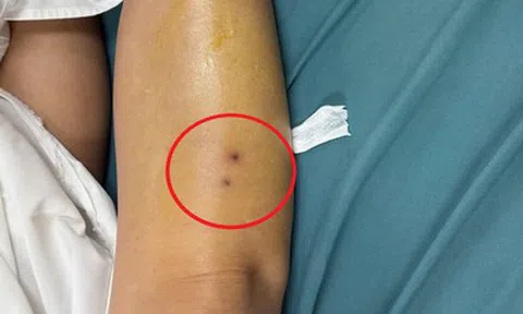 Suýt mất mạng vì rắn độc, người phụ nữ hồi phục thần kỳ sau 1 ngày điều trị