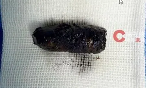 Mũi người đàn ông chảy dịch dai dẳng, bác sĩ phát hiện bí mật đáng sợ