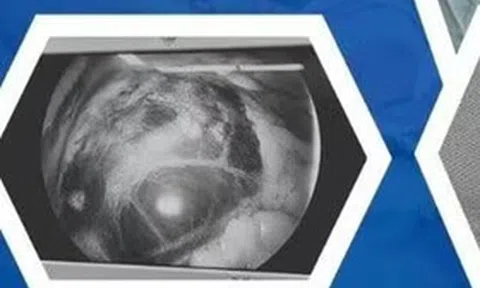 Chỉ đau bụng nhẹ nên chủ quan, người phụ nữ "chết lặng" khi phát hiện thai lạc chỗ ở vị trí cực kỳ nguy hiểm