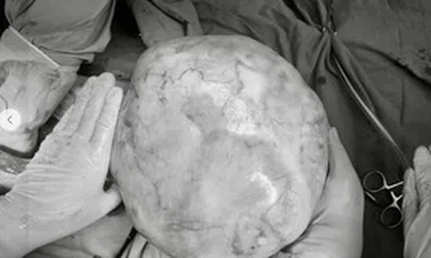 Bé gái 14 tuổi bụng to bất thường, bố mẹ sốc khi phát hiện bí mật "đáng sợ" bên trong