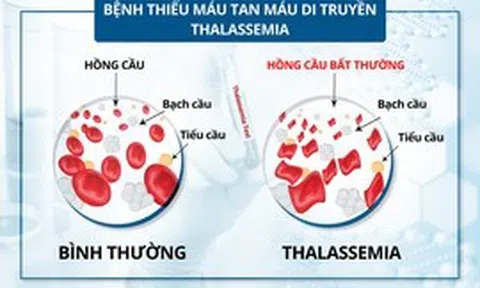 Bệnh tan máu bẩm sinh: Bệnh di truyền lặn nhưng phổ biến nhất ở Việt Nam và thế giới