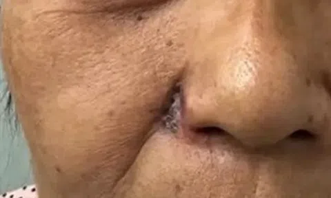 Nốt ruồi đổi màu bất thường, người phụ nữ "sốc" khi phát hiện căn bệnh này