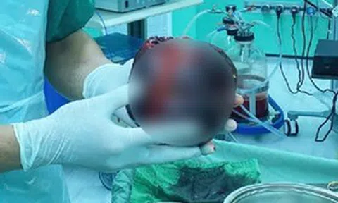 Đau bụng tưởng nhẹ, người đàn ông "sốc nặng" khi phát hiện thứ "đáng sợ" to bằng quả dưa lưới