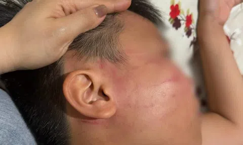 Vụ nam sinh lớp 4 bị giáo viên đánh bầm mặt: Bất ngờ phát hiện lớp dạy thêm tiếng Anh “chui”
