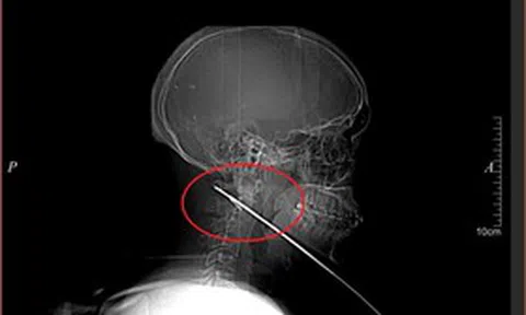 Nhập viện vì đau bất thường, nam bệnh nhân 27 tuổi khiến bác sĩ "sốc" khi lấy ra thứ không ngờ tới